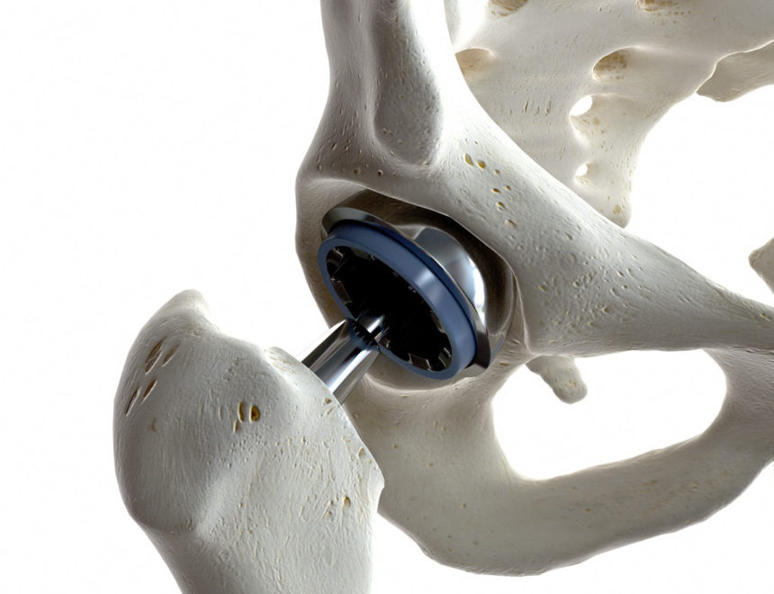 Protesi d’anca e materiali: quali le opzioni e le loro caratteristiche