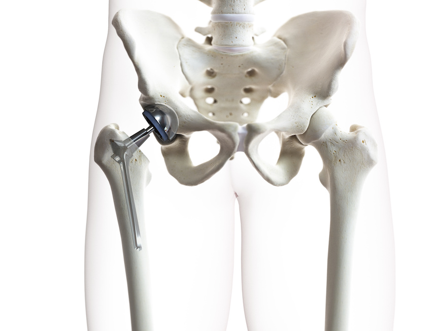 Tecnica mininvasiva per via anteriore: due nuovi casi di successo di artroprotesi d’anca
